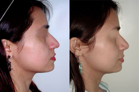 rhinoplasty--before-after-photos-5