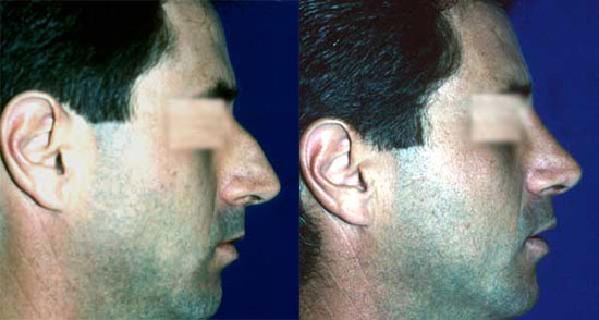 rhinoplasty--before-after-photos-8